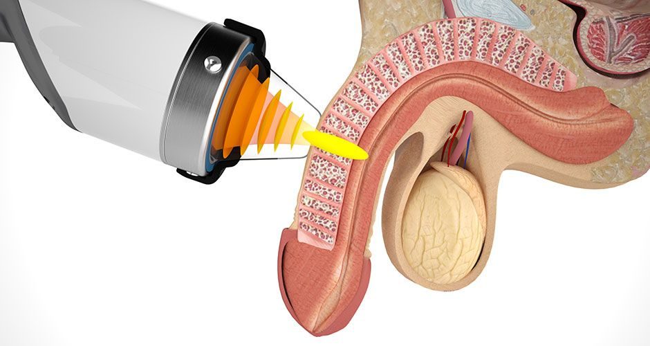 shockwave therapy for ED