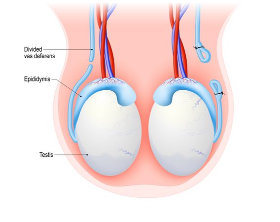 A medical illustration of the testicles showing a completed vasectomy procedure